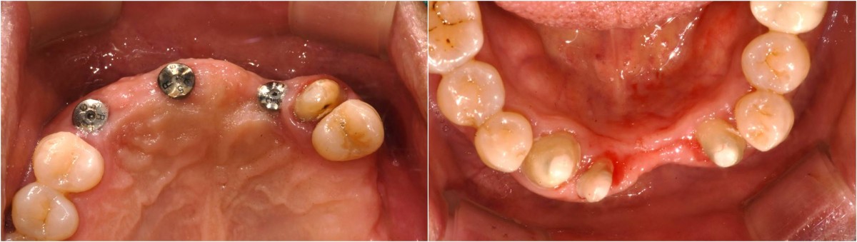 Intraoral photo before prosthesis delivery.