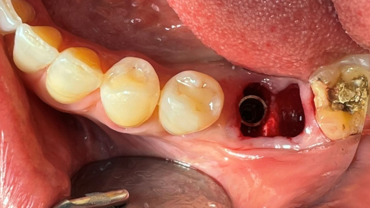placed implant