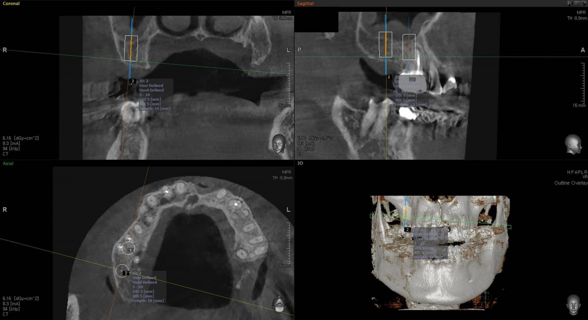 Surgery simulation on the OBCT image before implant placement