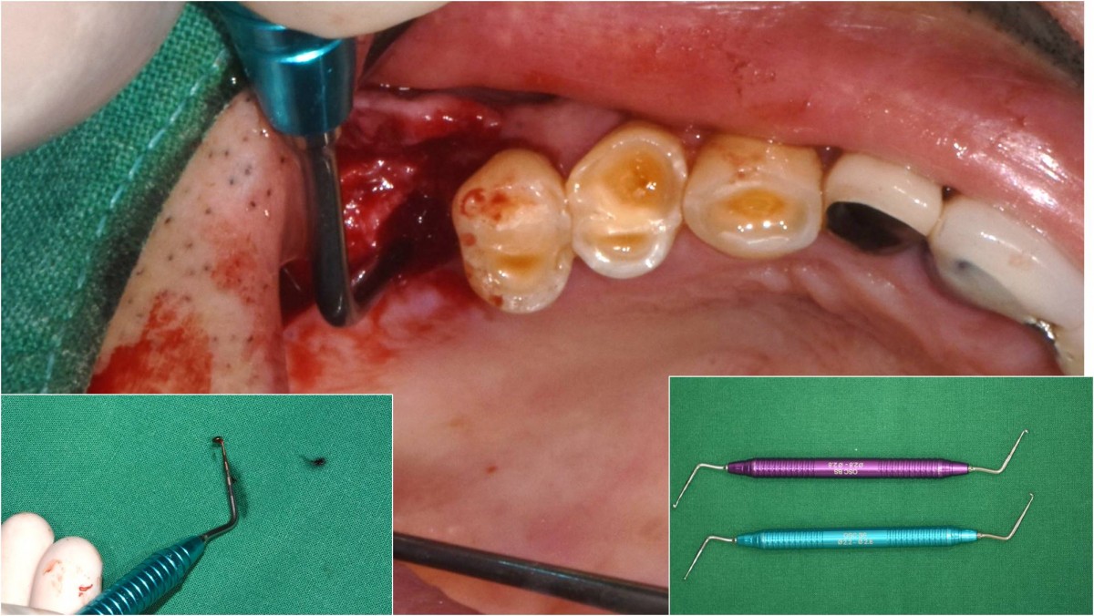 The Membrane-Lifter was applied to lift the sinus membrane.