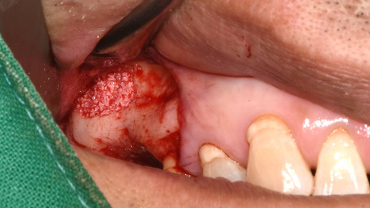 Bone material(Xenograft) was applied into the prepared sinus cavity.