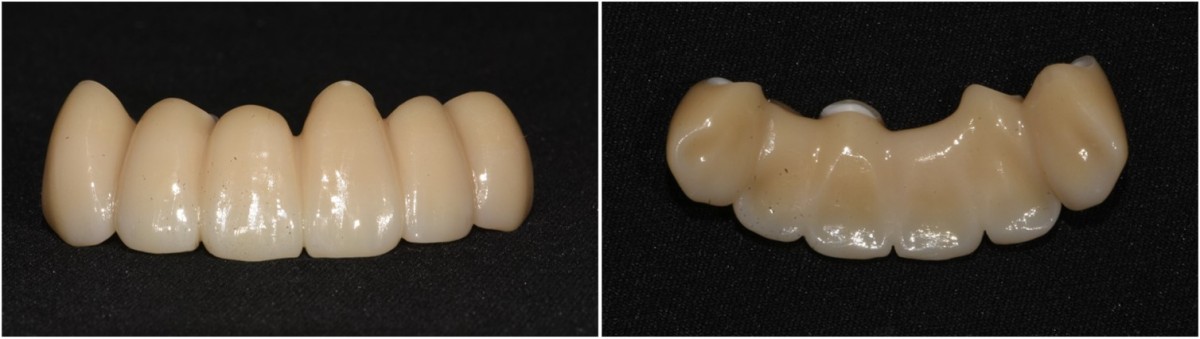 zirconia prosthesis