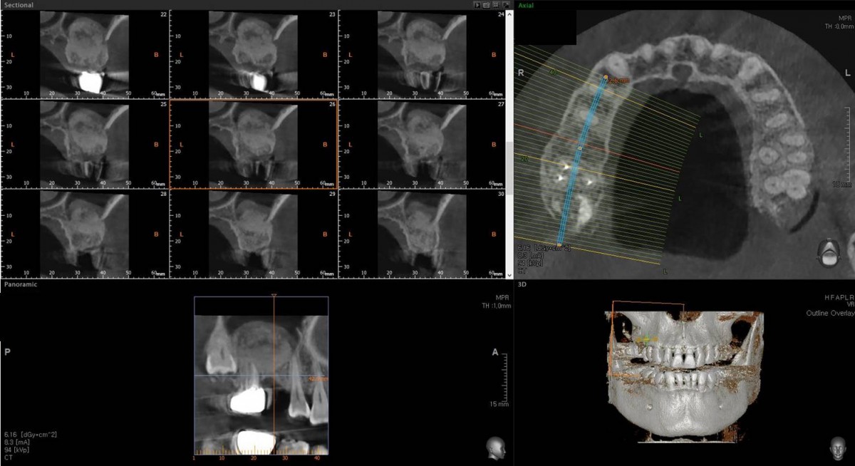 CBCT after 1month of maxillary sinus graft