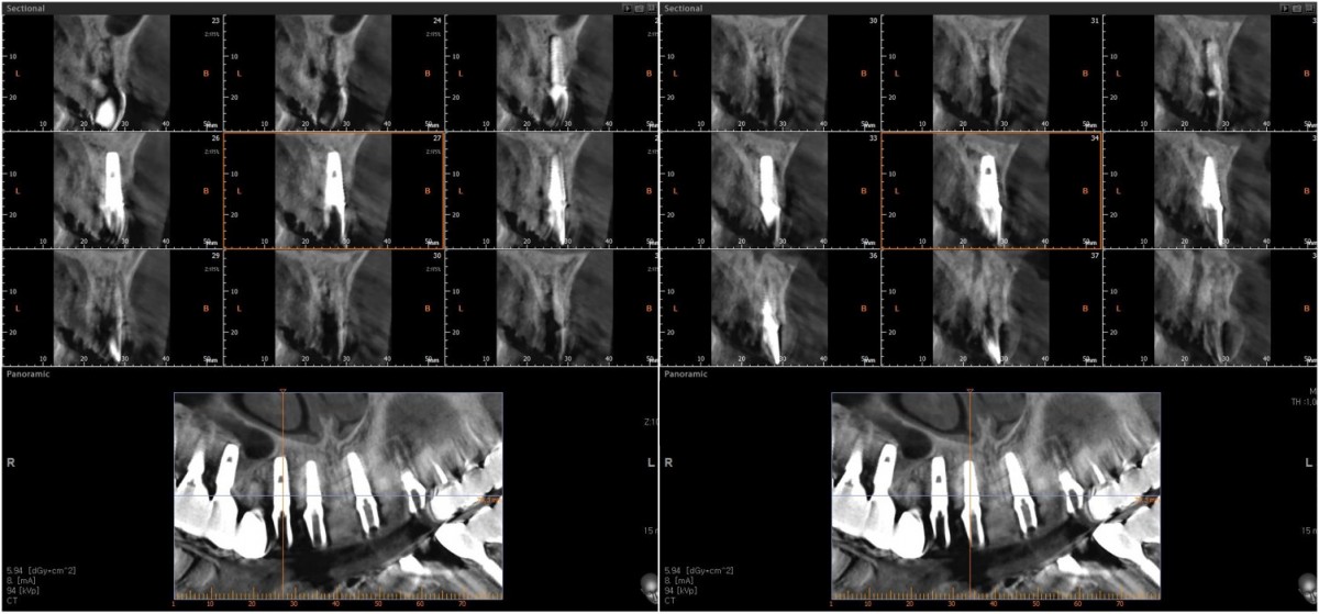 CBCT scan image after abutments connection