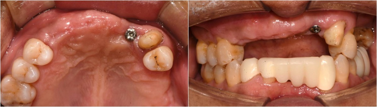 4 months after implant placement.