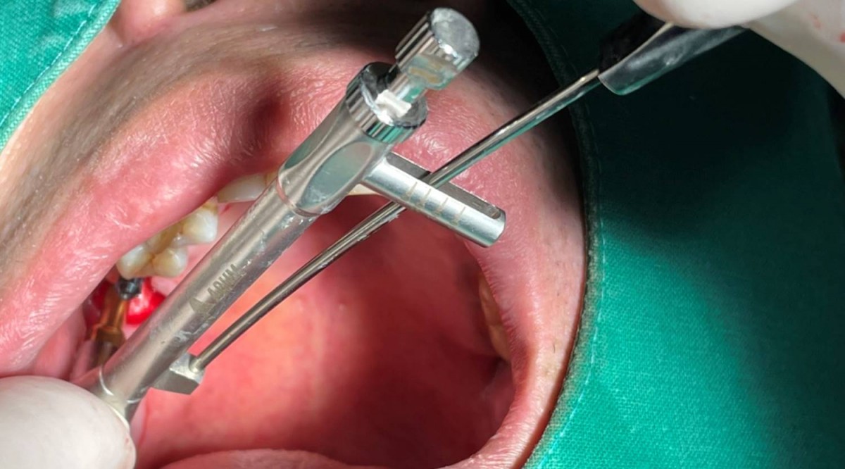 Insertion torque at the 2nd molar zone was 20Ncm. Arum NB1, 5*10