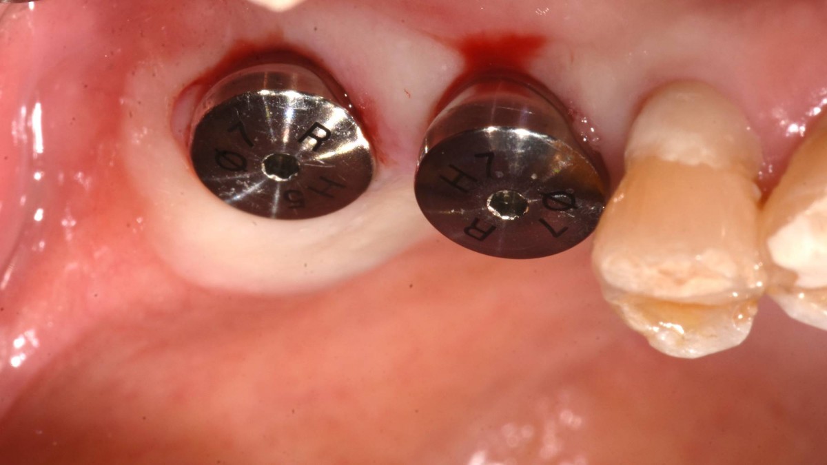 Healing abutments were engaged to the implant