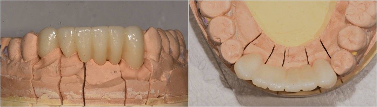 Lower anterior prosthesis.