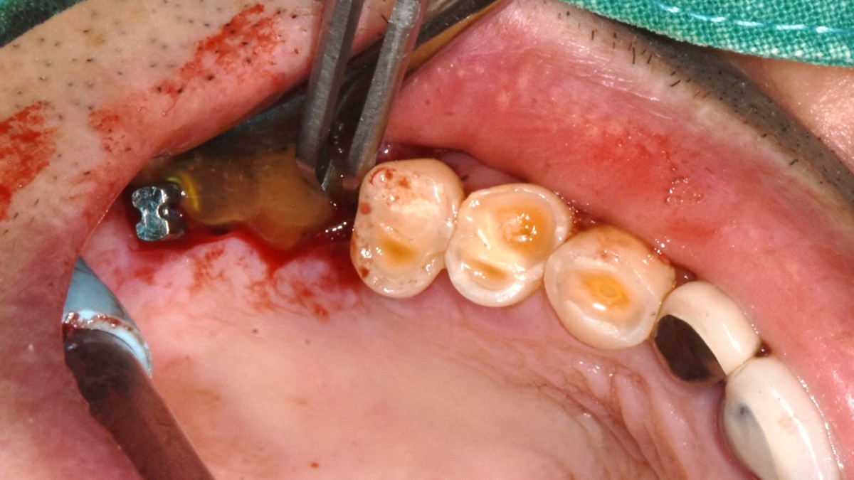 CGF was applied after osteotomy using sinus reamers.