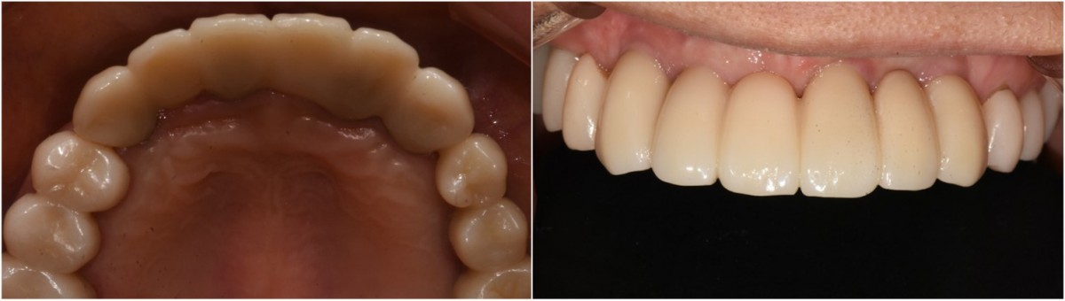 An implant-supported fixed partial denture