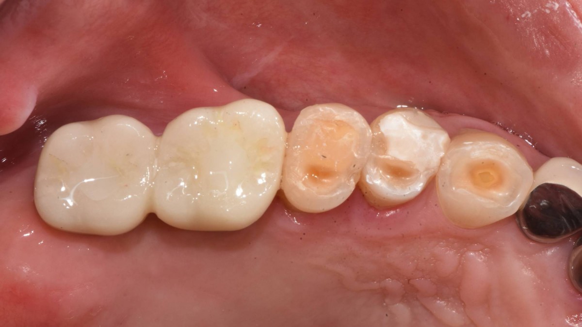 The crown was cemented permanently and the access hole was filled with composite resin.