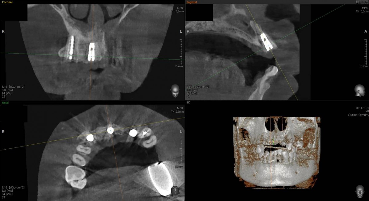 Central incisor zone