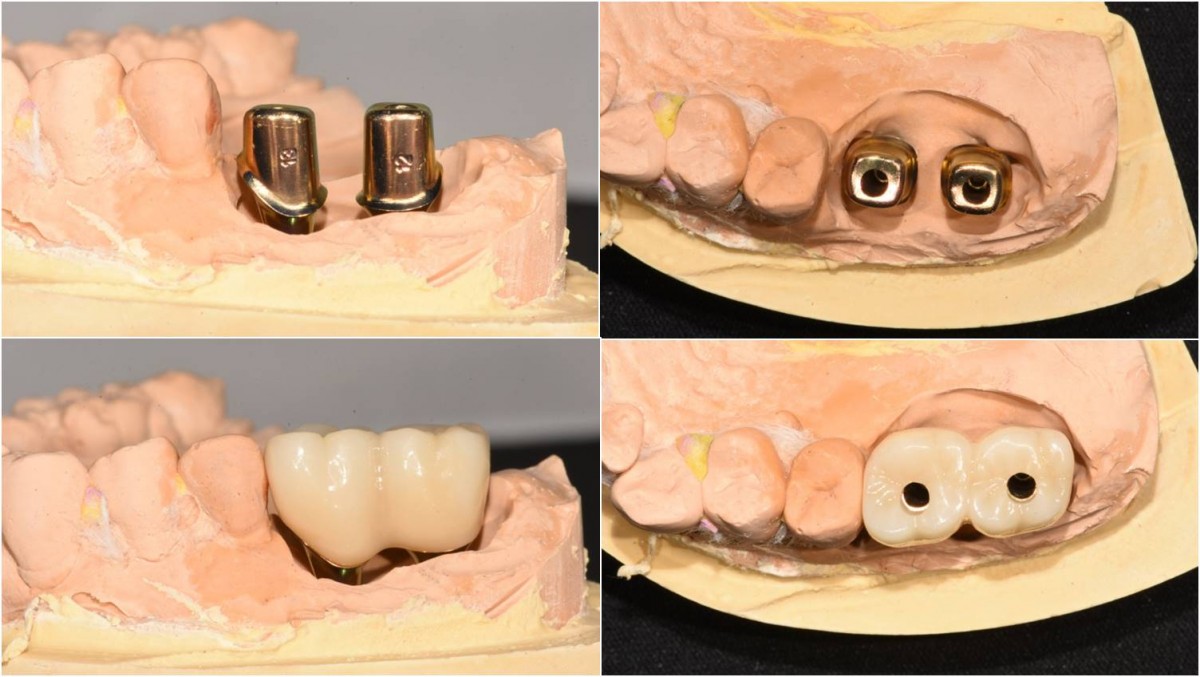 When viewed from the side, the embrasure area was not opened enough. That should be re-contoured.