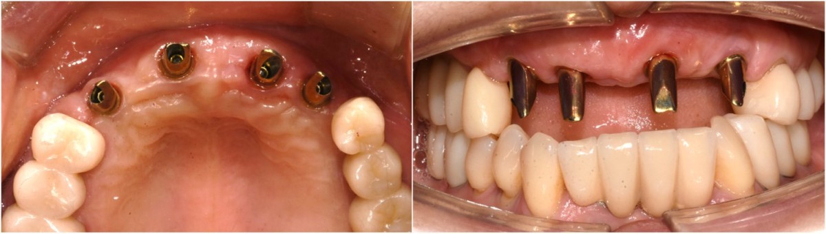 abutments were conneced in the mouth.