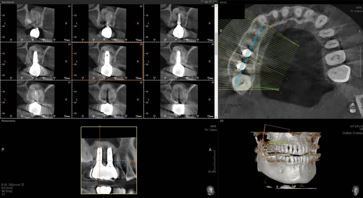 CBCT scan focused on 2nd molar area after crown cementation.