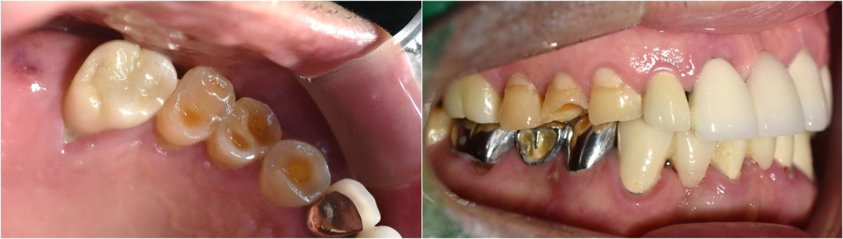 Initial intraoral view