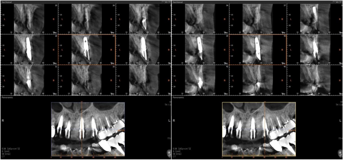 CBCT scan image after abutments connection