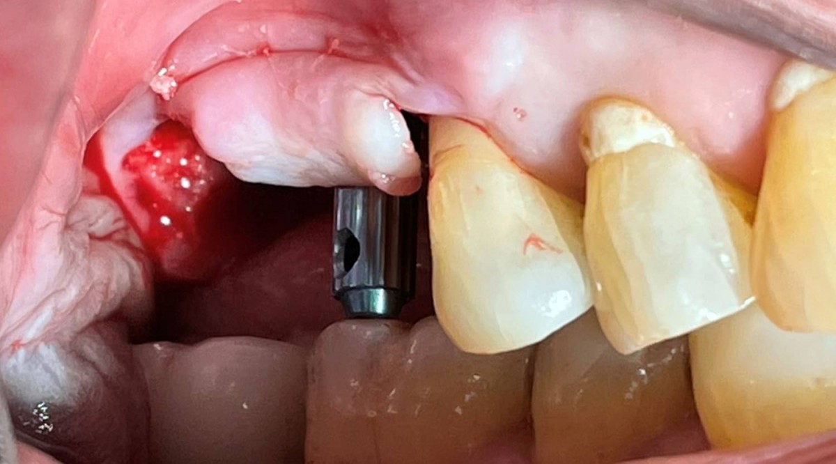 Lateral view. Check the 3-dimensional position and occlusal relationship with the Arum direction pin.