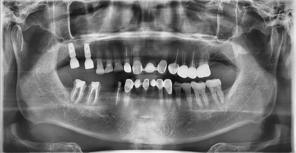 scan abutments were connected and a panoramic radiograph was taken to make sure of the connection.