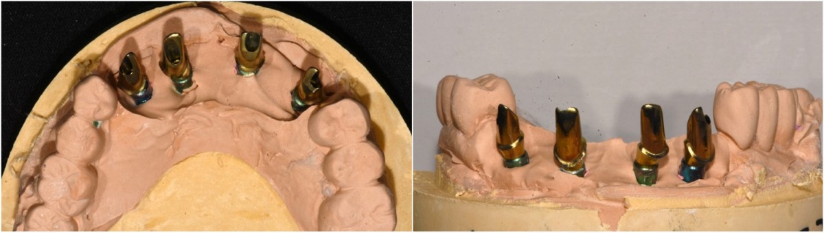 Customized abutment on the working model