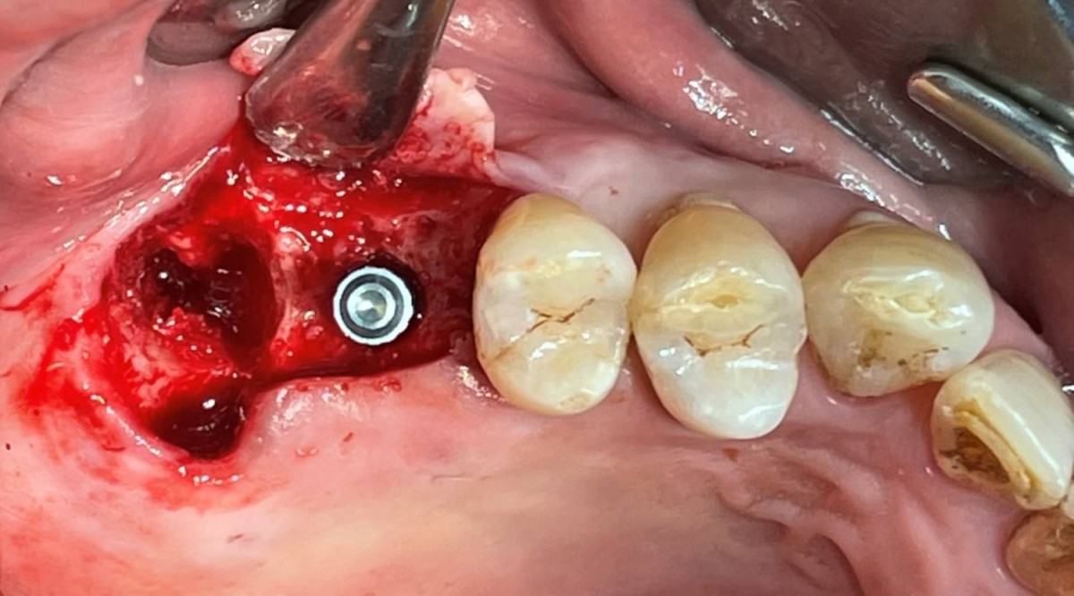 Occlusal view. Check the 3-dimensional position and occlusal relationship with the Arum direction pin.