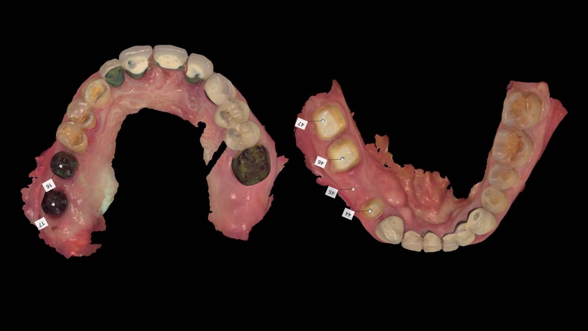 Intraoral scanning for digital impression