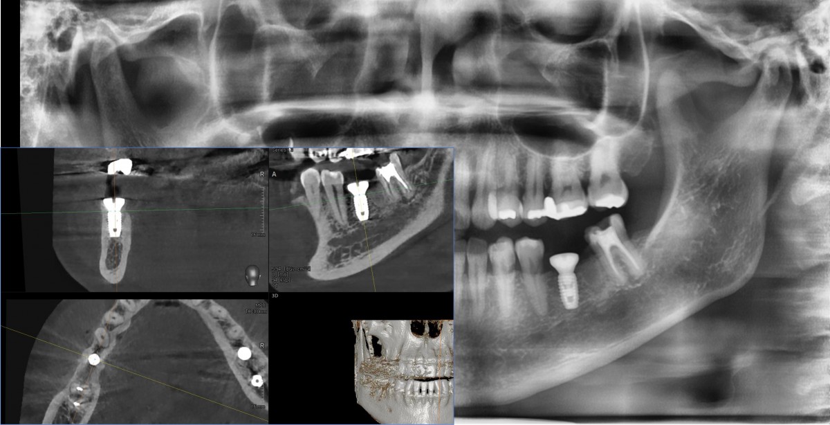 post-op radiograph.