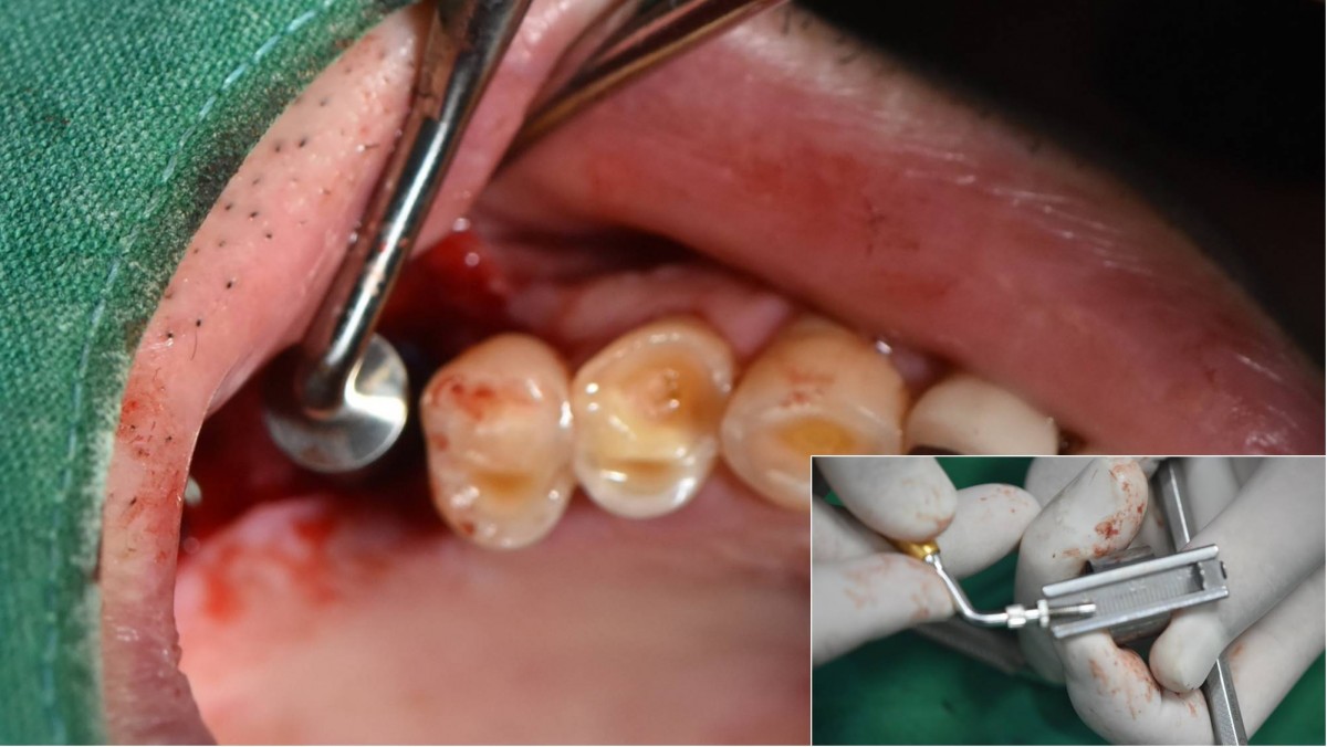 Choice of graft material was applied into the osteotomy site then was pushed up using a Bone-Packer and Sinus-Lifter.