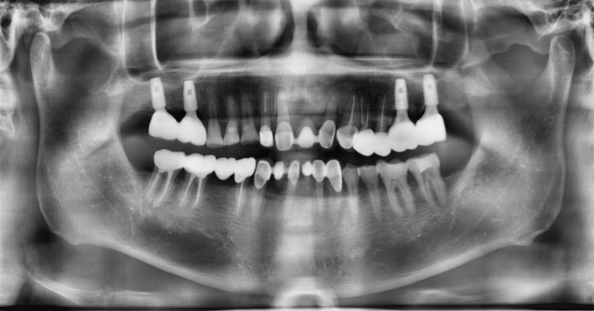 panoramic radiograph. almost 1 year later.