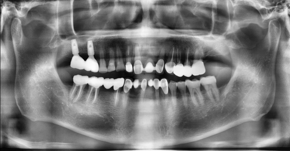 Panoramic radiograph was taken after restoration delivery