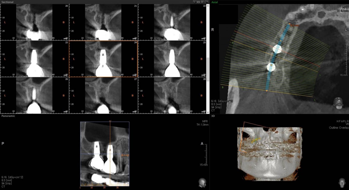 CBCT after restoration delivery