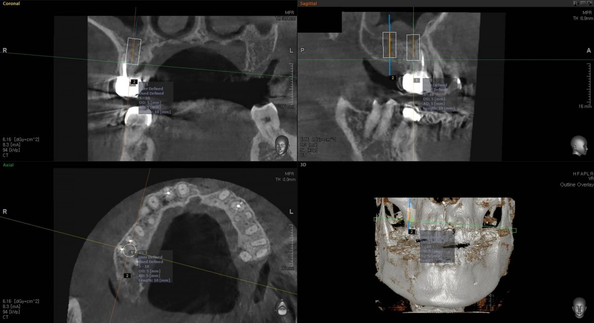 Surgery simulation on the OBCT image before implant placement