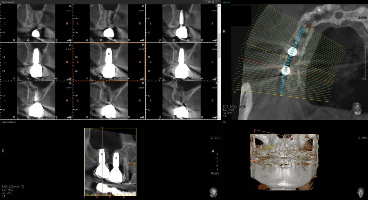 CBCT after restoration delivery