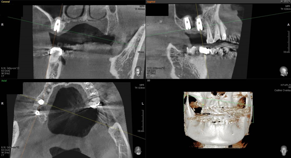 CBCT scan image focused on 1st molar zone