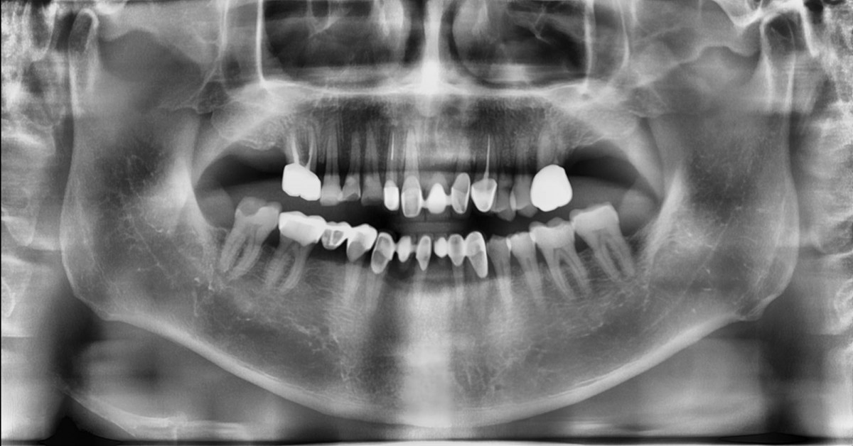 Panoramic radiograph