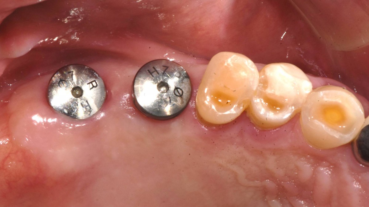 5months post-op. The healing abutments would be switched with scan abutments for intra-oral scanning.