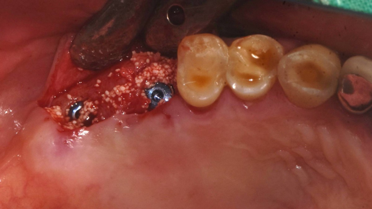   2 implants were placed in position with Arum-Dentistry NB-1 Ø5.0/L10mm. Initial stability was 50Ncm in the 1st molar area and 40Ncm in the 2nd molar area. 