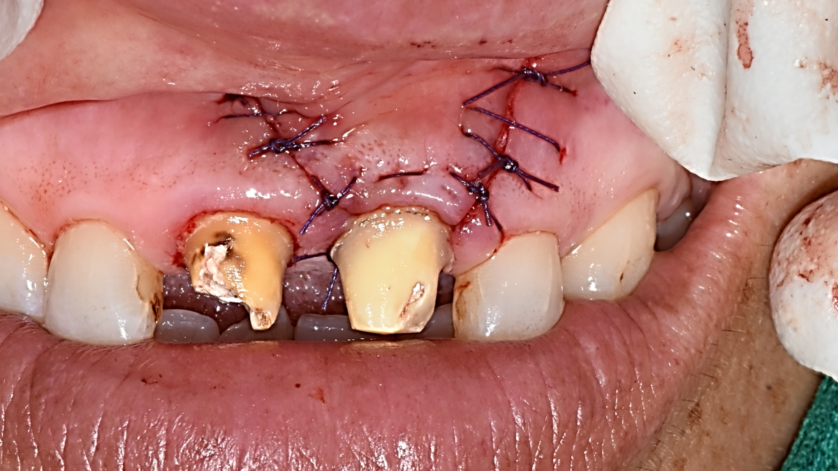 Suture