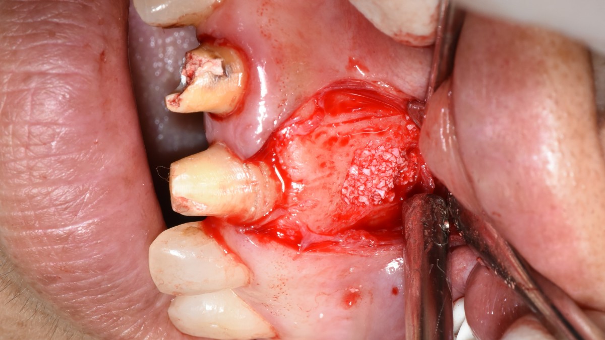 After resecting the root tip, GBR was performed on the defective area.(xenograft, collagen membrane)