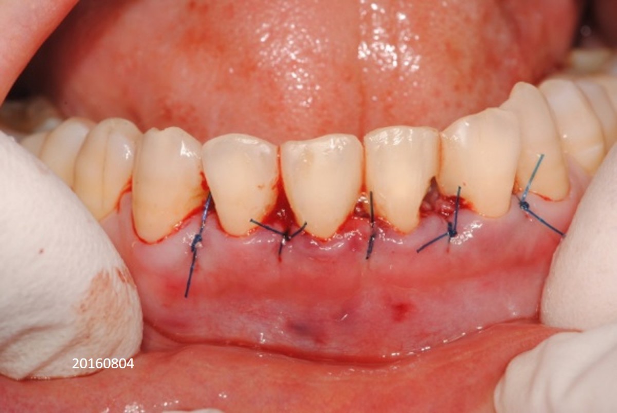 Suture