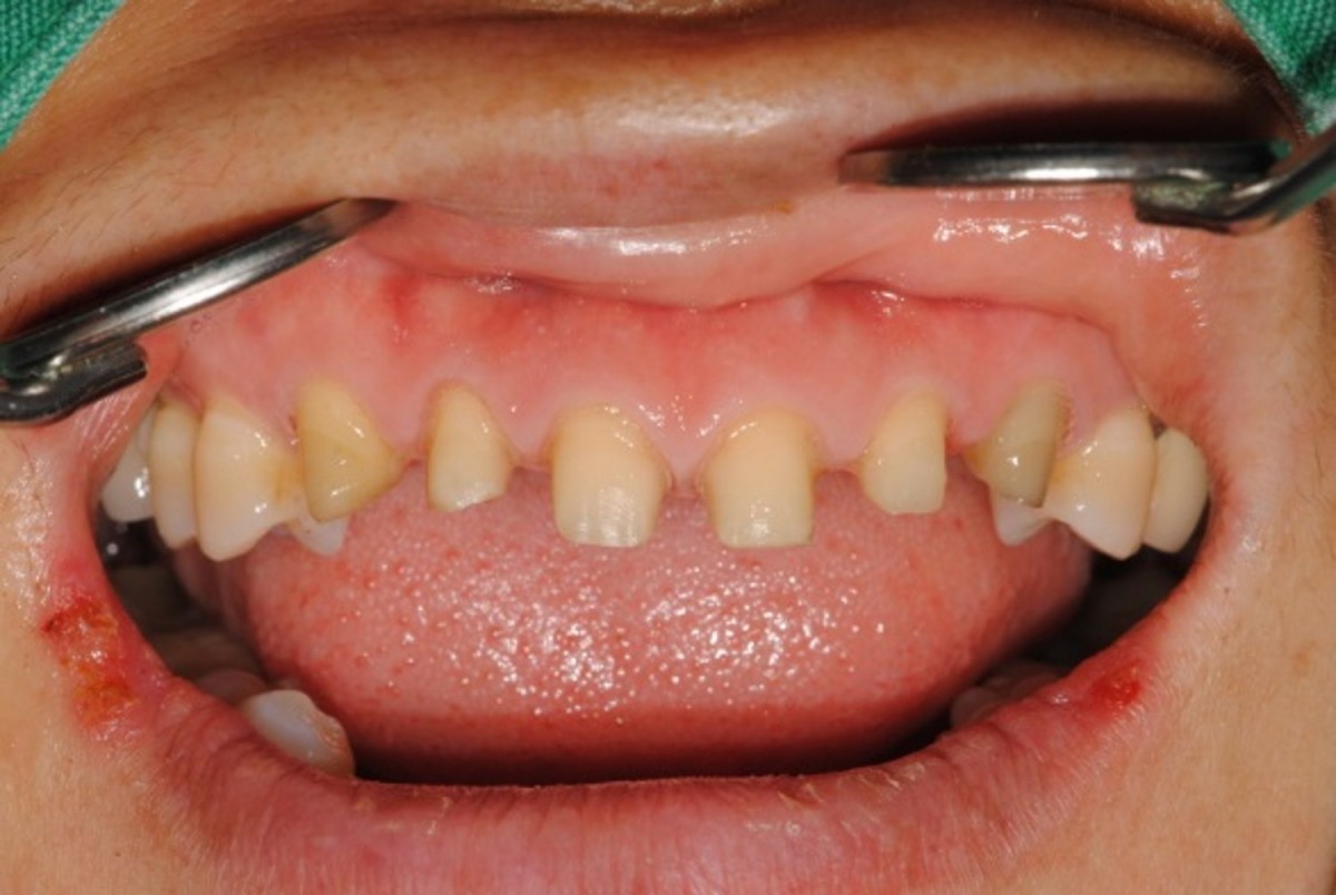tooth preparation