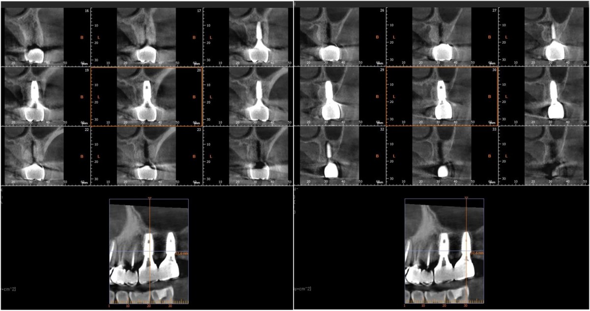 CBCT