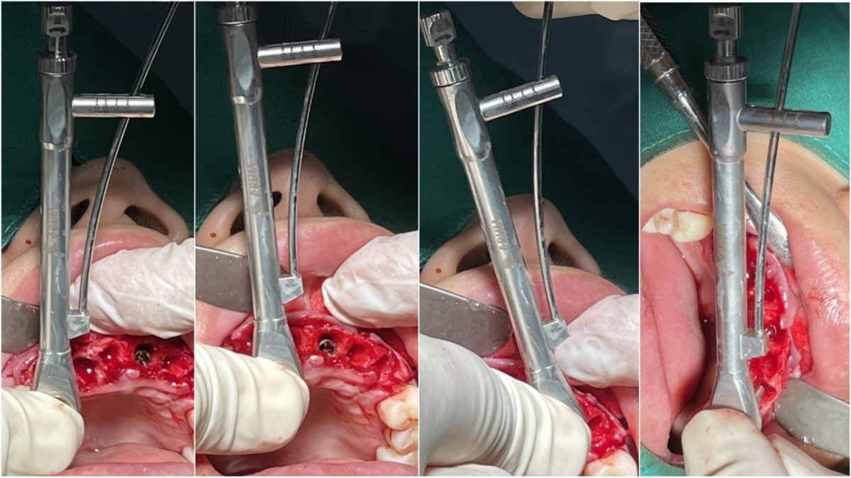 Initial stability value for each implant Arum Dentistry NB1 implant system.  Right and left canine 4*11.5, right lateral incisor and left central incisor 4.0*10