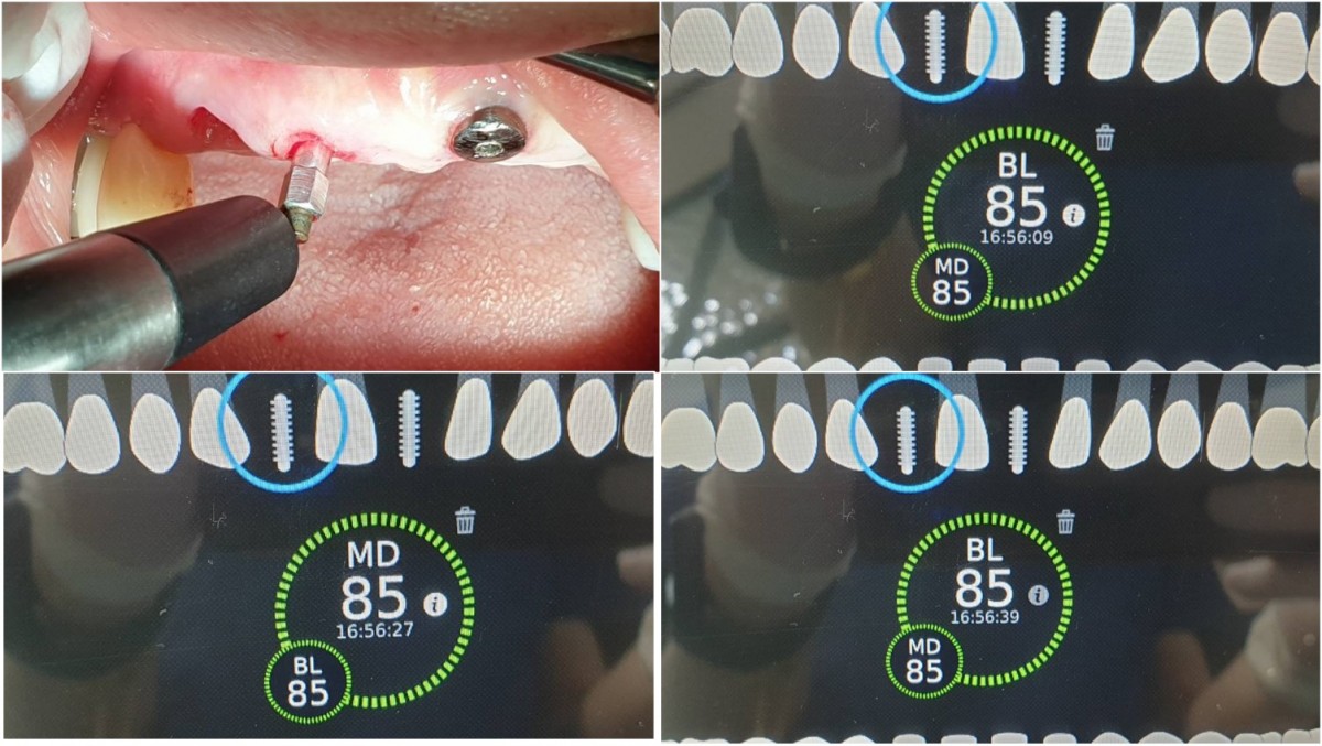 ISQ reading of the fixture in the lateral incisor on the day of 2nd surgery after 18 weeks of implant placement.