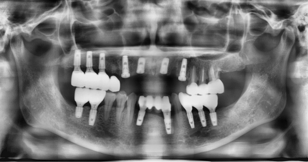 Post-op panoramic radiograph