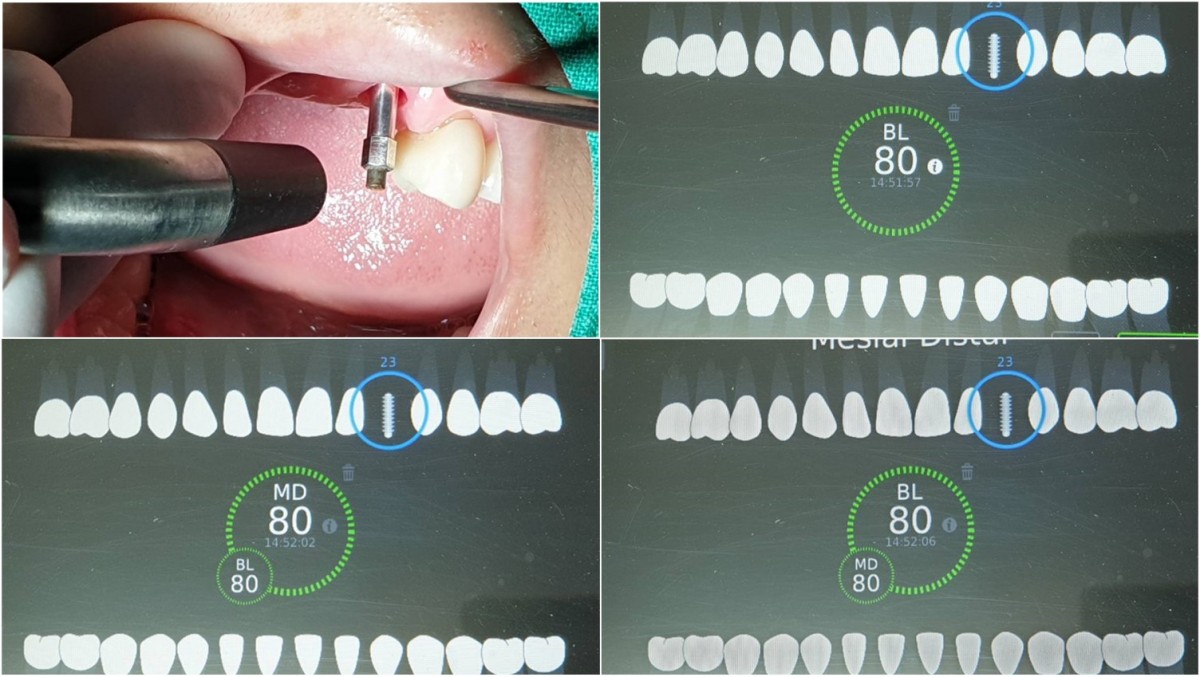 ISQ reading of left canines after 16 weeks of implant placement.