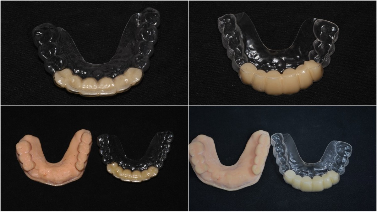 Removable provisional restoration.