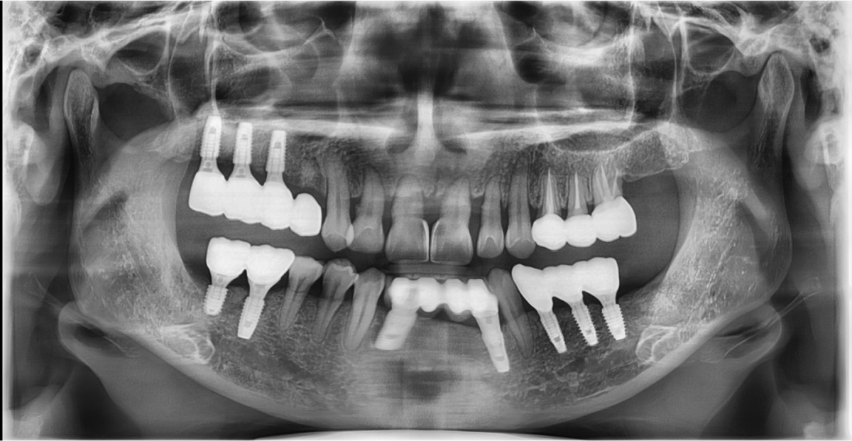 Pre-op panoramic radiograph.