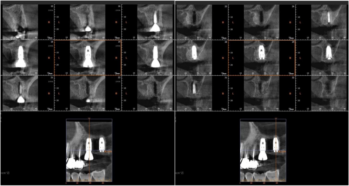 Post-op. CBCT