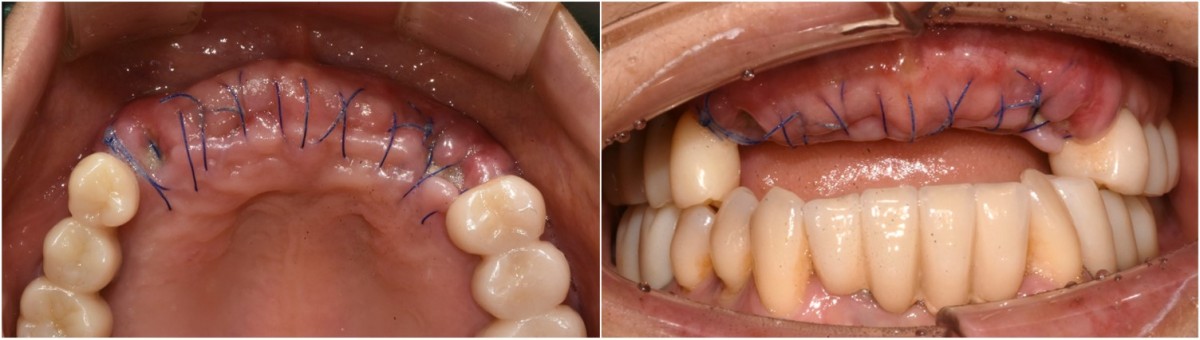 2 weeks post-op, intraoral photo on the day of suture removal.